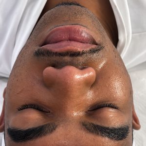 Hydra-facial-0.4