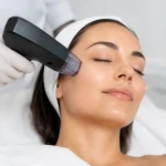 Morpheus8 Treatment Benefits for Smoother Skin
