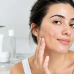 Top Options for Acne Scars That Actually Work